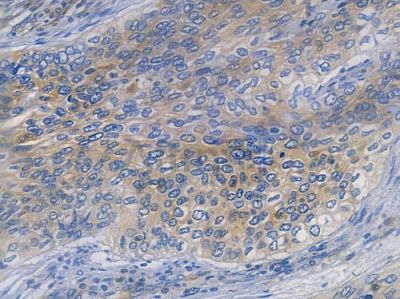 GCN2 Recombinant Rabbit mAb - BF3380 at 1/100 staining human cervical carcinoma by IHC-P.