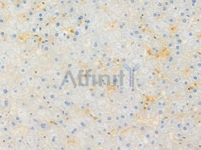 Progesterone Receptor Recombinant Rabbit mAb - BF3384 at 1/100 staining human cervical carcinoma by IHC-P.