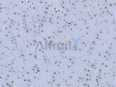 TDP43 Recombinant Rabbit mAb - BF3397 at 1/100 staining human glioblastoma by IHC-P.