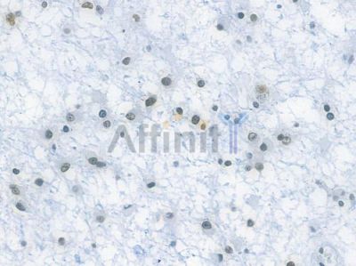 TDP43 Recombinant Rabbit mAb - BF3397 at 1/100 staining human astrocytoma by IHC-P.