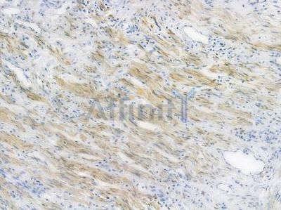 NAMPT Recombinant Rabbit mAb - BF3402 at 1/100 staining human colon carcinoma by IHC-P.
