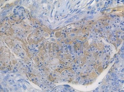 IL12A Recombinant Rabbit mAb - BF3417 at 1/100 staining human esophageal carcinoma by IHC-P.