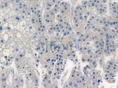 Survivin Recombinant Rabbit mAb - BF3422 at 1/100 staining human hepatocellular carcinoma by IHC-P.