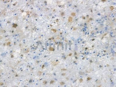 PGP9.5 Recombinant Rabbit mAb - BF3435 at 1/100 staining human astrocytoma by IHC-P.