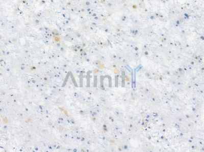 p27 Kip1 Recombinant Rabbit mAb - BF3436 at 1/100 staining human astrocytoma by IHC-P.