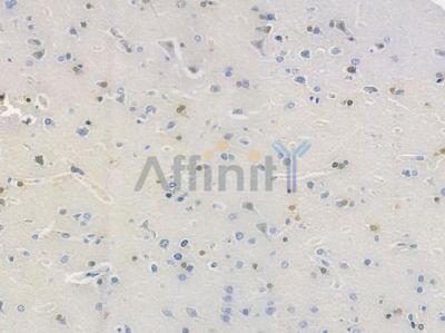 p27 Kip1 Recombinant Rabbit mAb - BF3436 at 1/100 staining human glioblastoma by IHC-P.