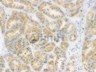 BAD Recombinant Rabbit mAb - BF3439 at 1/100 staining human renal cell carcinoma by IHC-P.