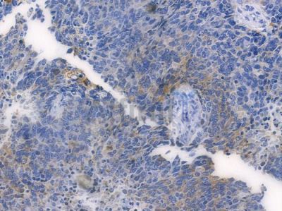 HER2/ErbB2 Recombinant Rabbit mAb - BF3440 at 1/100 staining human large cell lung carcinoma by IHC-P.
