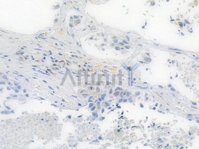 RAD51 Recombinant Rabbit mAb - BF3442 at 1/100 staining human lung squamous cell carcinoma by IHC-P.