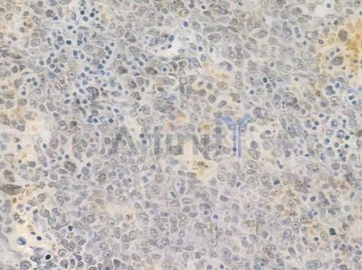 NRF1 Recombinant Rabbit mAb - BF3456 at 1/100 staining human melanoma by IHC-P.