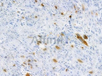 TNNT2 Recombinant Rabbit mAb - BF3461 at 1/100 staining human tongue carcinoma by IHC-P.