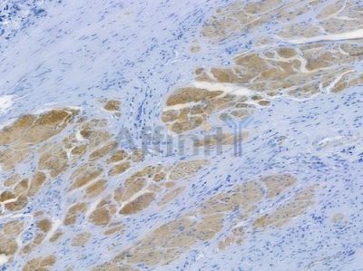 Desmin Recombinant Rabbit mAb - BF3466 at 1/100 staining human prostate carcinoma by IHC-P.
