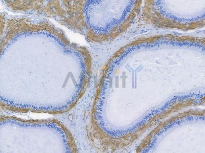 Desmin Recombinant Rabbit mAb - BF3466 at 1/100 staining human testicular cancer by IHC-P.
