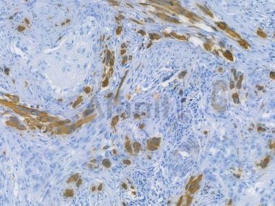 Desmin Recombinant Rabbit mAb - BF3466 at 1/100 staining human tongue carcinoma by IHC-P.