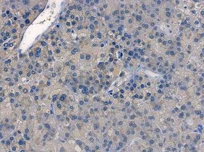 Catalase Recombinant Rabbit mAb - BF3479 at 1/100 staining human hepatocellular carcinoma by IHC-P.