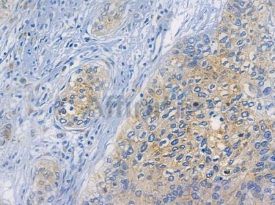 FGFR3 Recombinant Rabbit mAb - BF3497 at 1/100 staining human cervical carcinoma by IHC-P.