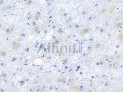 FGFR3 Recombinant Rabbit mAb - BF3497 at 1/100 staining human astrocytoma by IHC-P.