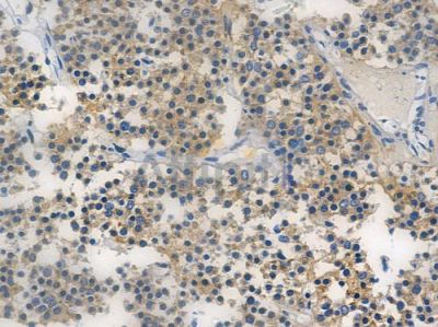 FGFR3 Recombinant Rabbit mAb - BF3497 at 1/100 staining human pituitary adenoma by IHC-P.