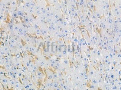 Phospho-PKC (Ser660) Recombinant Rabbit mAb - BF3506 at 1/100 staining human hepatocellular carcinoma by IHC-P.