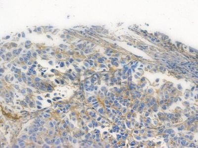 Integrin  alpha V Recombinant Rabbit mAb - BF3511 at 1/100 staining human lung squamous cell carcinoma by IHC-P.