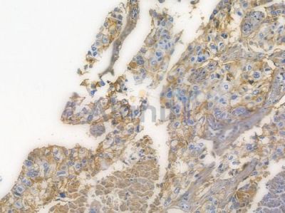 Integrin  alpha V Recombinant Rabbit mAb - BF3511 at 1/100 staining human lung squamous cell carcinoma by IHC-P.