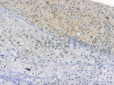 SP1 Recombinant Rabbit mAb - BF3512 at 1/100 staining human hepatocellular carcinoma by IHC-P.