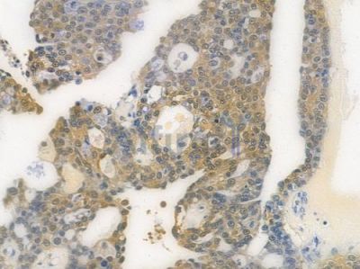 ENO1 Recombinant Rabbit mAb - BF3552 at 1/100 staining human ovarian carcinoma by IHC-P.