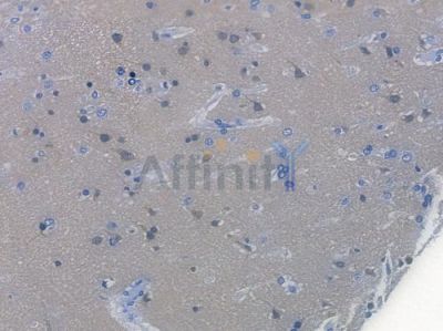GSK3 alpha/ beta Recombinant Rabbit mAb - BF3554 at 1/100 staining human glioblastoma by IHC-P.