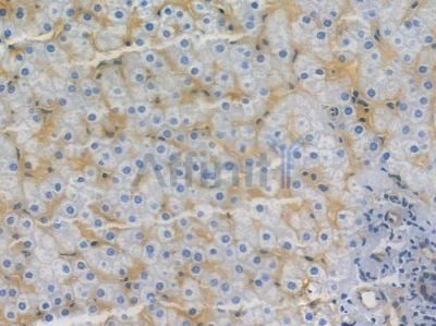 Phospho-GSK3 (alpha/beta) (Tyr279/Tyr216) Recombinant Rabbit mAb - BF3555 at 1/100 staining human hepatocellular carcinoma by IHC-P.