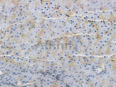 Phospho-GSK3 (alpha/beta) (Tyr279/Tyr216) Recombinant Rabbit mAb - BF3555 at 1/100 staining human hepatocellular carcinoma by IHC-P.