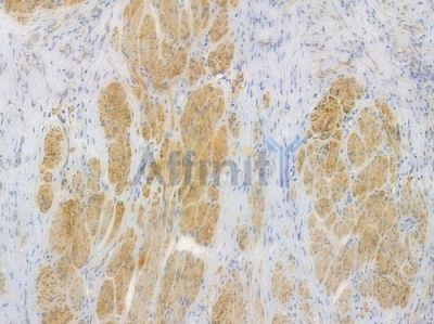 Phospho-GSK3 (alpha/beta) (Tyr279/Tyr216) Recombinant Rabbit mAb - BF3555 at 1/100 staining human prostate carcinoma by IHC-P.