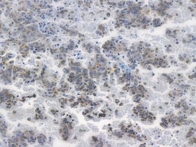 PFKFB3 Recombinant Rabbit mAb - BF3558 at 1/100 staining human melanoma by IHC-P.