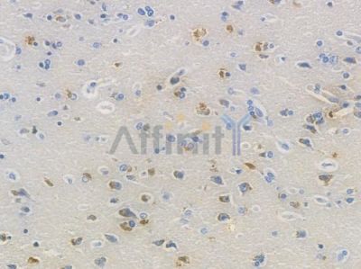 RPS6 Recombinant Rabbit mAb - BF3580 at 1/100 staining human glioblastoma by IHC-P.