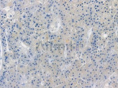 NRP1 Recombinant Rabbit mAb - BF3582 at 1/100 staining human hepatocellular carcinoma by IHC-P.