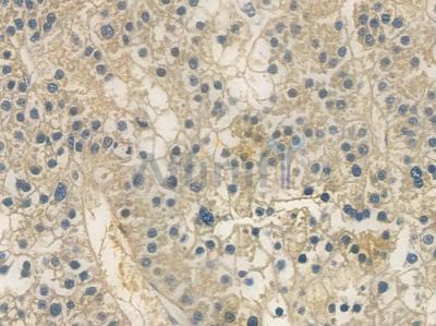 Lamin A/C Recombinant Rabbit mAb - BF3583 at 1/100 staining human hepatocellular carcinoma by IHC-P.