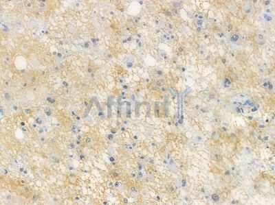 HDAC2 Recombinant Rabbit mAb - BF3604 at 1/100 staining human astrocytoma by IHC-P.