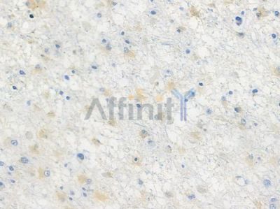 CCR3 Recombinant Rabbit mAb - BF3616 at 1/100 staining human astrocytoma by IHC-P.