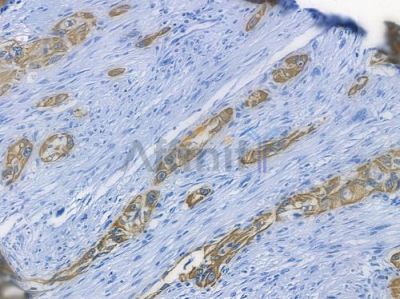 Cytokeratin 5 Recombinant Rabbit mAb - BF3619 at 1/100 staining human tongue carcinoma by IHC-P.