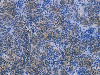 Cytokeratin 5 Recombinant Rabbit mAb - BF3619 at 1/100 staining human thymoma by IHC-P.