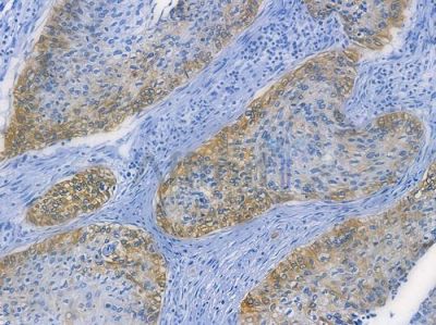 Cytokeratin 5 Recombinant Rabbit mAb - BF3619 at 1/100 staining human cervical carcinoma by IHC-P.