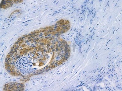 Cytokeratin 5 Recombinant Rabbit mAb - BF3619 at 1/100 staining human esophageal carcinoma by IHC-P.