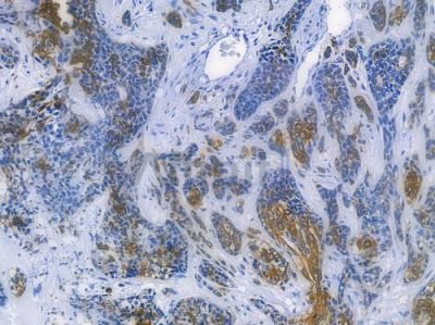 Cytokeratin 5 Recombinant Rabbit mAb - BF3619 at 1/100 staining human breast carcinoma by IHC-P.