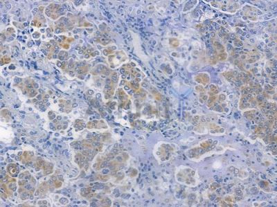Bak Recombinant Rabbit mAb - BF3633 at 1/100 staining human lung adenocarcinoma by IHC-P.