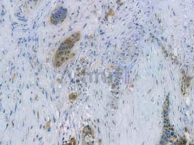 Galectin 3 Recombinant Rabbit mAb - BF3647 at 1/100 staining human pancreatic carcinoma by IHC-P.