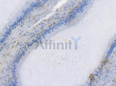 Galectin 3 Recombinant Rabbit mAb - BF3647 at 1/100 staining human testicular cancer by IHC-P.