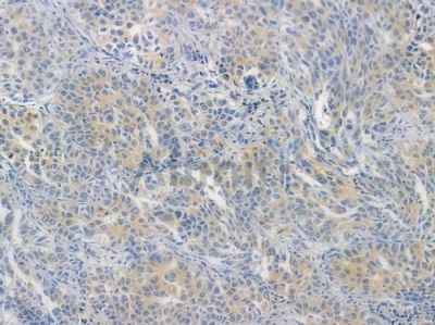 HDAC3 Recombinant Rabbit mAb - BF3650 at 1/100 staining human lung squamous cell carcinoma by IHC-P.
