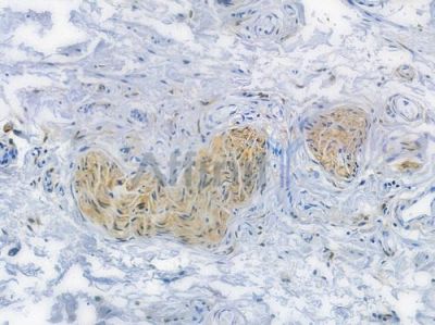 Integrin  alpha 5 Recombinant Rabbit mAb - BF3652 at 1/100 staining human testicular cancer by IHC-P.