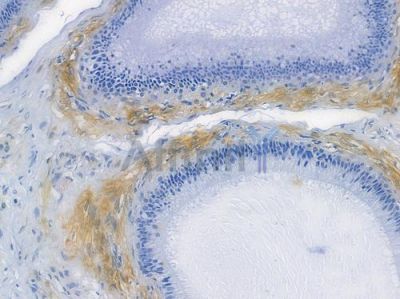 PKR Recombinant Rabbit mAb - BF3658 at 1/100 staining human testicular cancer by IHC-P.