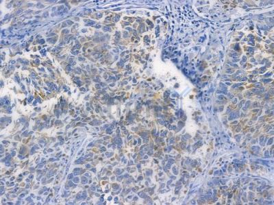 CPT2 Recombinant Rabbit mAb - BF3667 at 1/100 staining human lung squamous cell carcinoma by IHC-P.