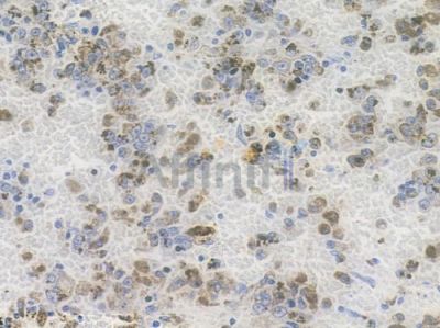GCLM Recombinant Rabbit mAb - BF3676 at 1/100 staining human melanoma by IHC-P.